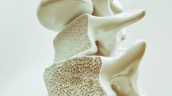 Osteoporosis On The Spine